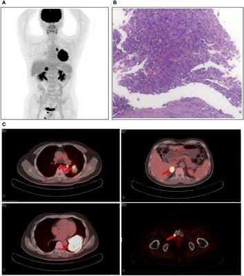 Pathological complete remission in ALK-positive lung cancer patient after multiple lines of conversion therapy